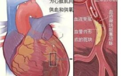 心肌梗塞是什么症状,识别与应对关键